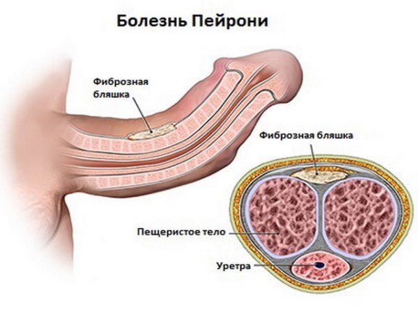 болезнь пейрони у мужчин