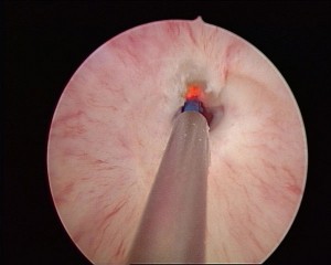 пластика стриктуры уретры